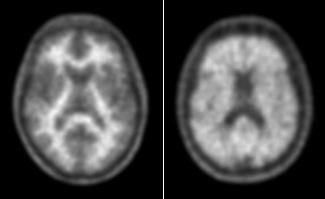 New Data Presented on Neuraceq Amyloid Plaque Imaging Agent at SNMMI 2014