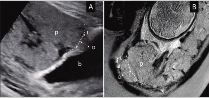 A) Ultrasound in 28-year-old woman (B) MRI in 34-year-old woman with suspected PAS disorder. Focal area of placental tissues bulge toward imaginary lines of normal uterine contour (dash lines). Length (L) and depth (D) measurements of placental bulge also demonstrated. p = placenta; b = bladder. Image courtesy of American Roentgen Ray Society (ARRS), American Journal of Roentgenology (AJR)