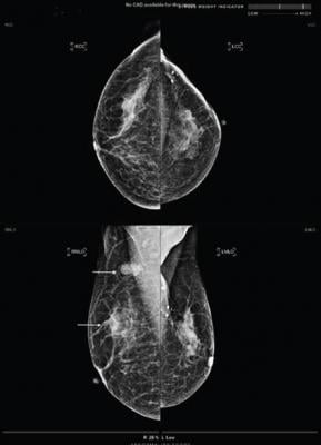 artificial intelligence-based computer-aided detection (AI-CAD) can be a practical addition for lowering false-positive findings when performing post-breast conserving therapy (BCT) surveillance mammography