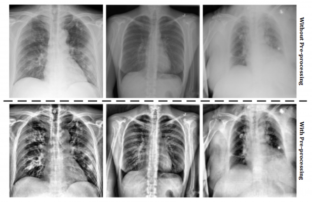Medical professionals around the world have been feeding lung X-rays into a database since the beginning of the pandemic