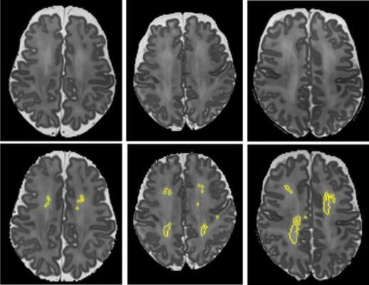 These MRI scans show diffuse white matter abnormality (DWMA). The top three panels display raw MRI images from very preterm infants born at 27 weeks (left), 26 weeks (center) and 31 weeks (right) gestation.