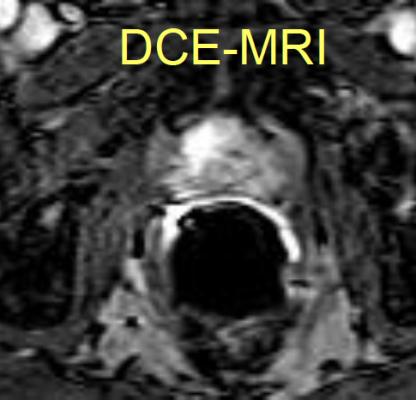 BPH, prostate, interventional radiology, PAE, embolization, SIR