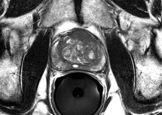 how to read prostate mri