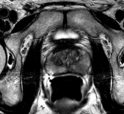  Prostate cancer MRI