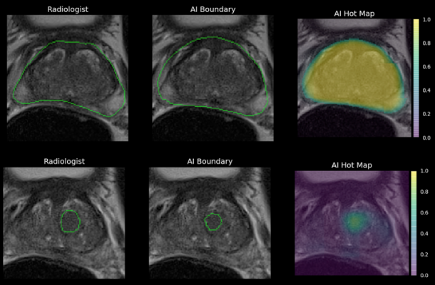 Ezra, a NY-based startup transforming early cancer screening using magnetic resonance imaging (MRI), announced that it has received FDA 510(k) premarket authorization for its Artificial Intelligence, designed to decrease the cost of MRI-based cancer screening, assisting radiologists in their analysis of prostate MRI scans. It is the first prostate AI to be cleared by the FDA.