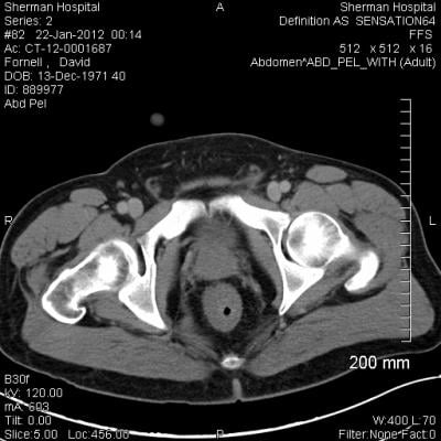 prostate cancer, ProtecT trial findings, ASTRO 2016, radiation therapy