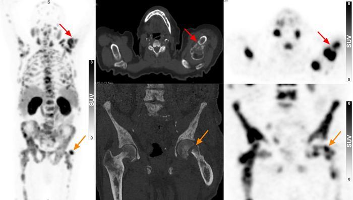 In elderly patients with suspected prostate cancer, PSMA PET/CT can diagnose advanced disease and aid in therapy selection without the need for a biopsy 