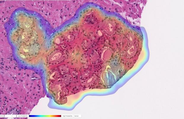 Prostate biopsy with cancer probability (blue is low, red is high). This case was originally diagnosed as benign but changed to cancer upon further review. The AI accurately detected cancer in this tricky case. Image courtesy of Ibex Medical Analytics