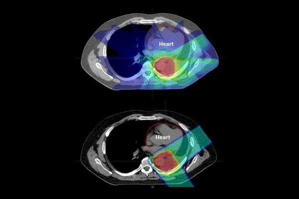 Treating lung cancer patients with proton therapy may help reduce the risk of radiation-induced heart diseases, suggests a new study from Penn Medicine. In a retrospective trial of more than 200 patients, mini-strokes were significantly less common among patients who underwent proton therapy versus conventional photon-based radiation therapy. Proton therapy patients also experienced fewer heart attacks.