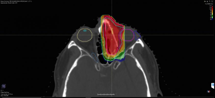 Mevion Receives 510(k) Clearance for Hyperscan Pencil Beam Scanning Proton Therapy