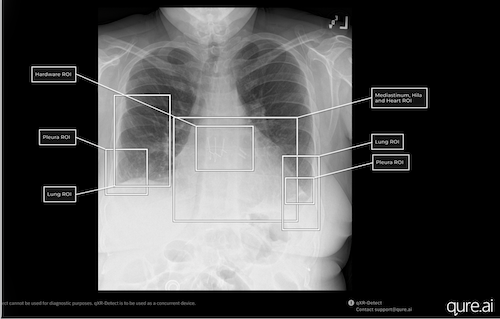 chest, x-ray, FDA, lung, Qure.ai