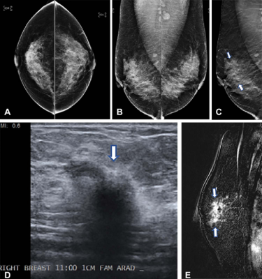 In a study of over a million women, digital breast tomosynthesis (DBT) showed improved breast cancer screening outcomes over screening with standard digital mammography alone. The results of the study were published in Radiology, a journal of the Radiological Society of North America (RSNA) 