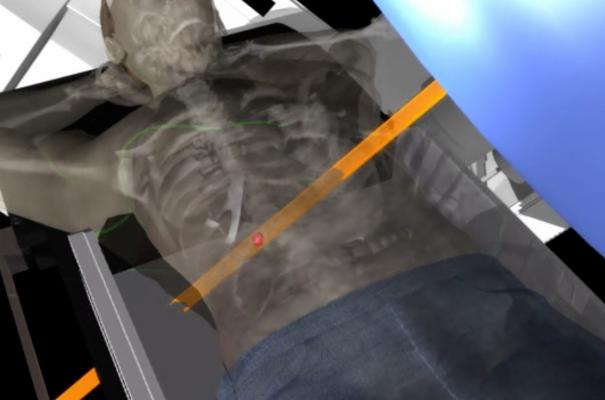 ASTRO study, radiation therapy, rectal cancer, travel burden