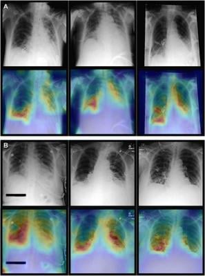 A new artificial intelligence (AI) model combines imaging information with clinical patient data to improve diagnostic performance on chest X-rays
