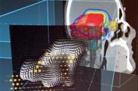 First European Patient Treated with RayStation Treatment Planning System