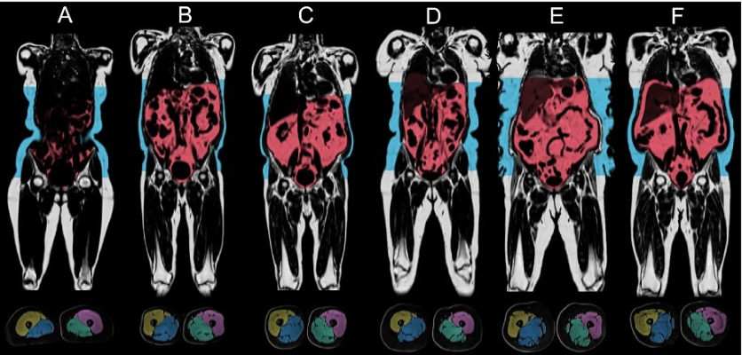 The collection of whole-body repeat imaging scans of 60,000 UK Biobank participants will provide researchers with a unique set of longitudinal measures to understand the determinants and progression of disease in mid-to-later life. 