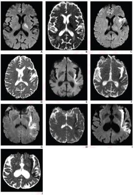 Acute ischemic stroke patients with each PIRI score on 5-point scale