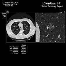 ClearRead CT with CVI Improves Chest Nodule Detection 