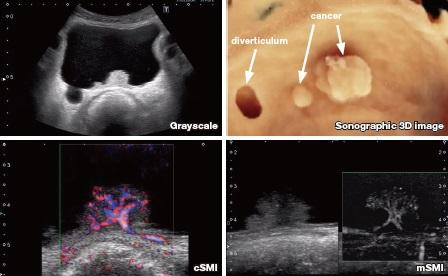 New Technology Enables Enhanced Blood Flow Visualization With Ultrasound