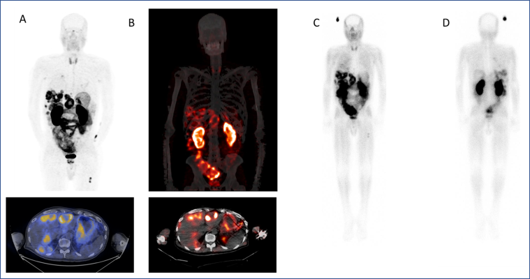 During its 2023 Annual Meeting, the Image of the Year was selected by the Society of Nuclear Medicine and Molecular Imaging (SNMMI), and represents research presented which reports on the ability of a novel theranostic pair to successfully detect metastatic pancreatic cancer and provide a means of selecting appropriate treatments.