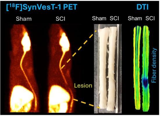 New Research Shows Novel PET Tracer Can Detect Synaptic Changes in Spinal Cord and Brain After Spinal Cord Injury