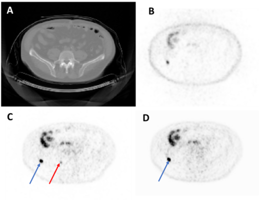Representative axial image from a test set imaging study. From top left to bottom right: CT (A), NAC-PET (B), original AC-PET (C), AI-generated AC-PET (D). The blue arrow indicates one lesion that was observed in both images, and the red arrow indicates a lesion that was missed (i.e., not de-tected by expert nuclear medicine physicians) in AI image. NAC = Non-Attenuation Corrected. AC = Attenuation-Corrected