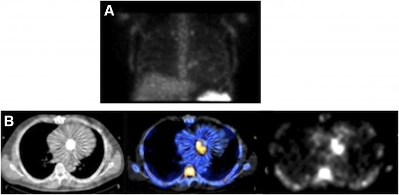 SPECT/CT Imaging Agent Solves Difficulty of Diagnosing Infectious Endocarditis