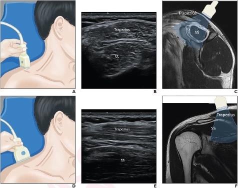 (A) Patient lies in supine and neutral position, gently stretches neck muscle, and turns head slightly to contralateral side. Transducer is initially placed with application of minimal pressure. (B) Supraspinatus and trapezius muscles identified in transverse plane. (C) Representation of view using sagittal T2-weighted MR image. (D) Transducer turned to longitudinal view. (E) Supraspinatus and trapezius muscles visualized along longitudinal orientation of muscle fibers. (F) Representation of view using coro