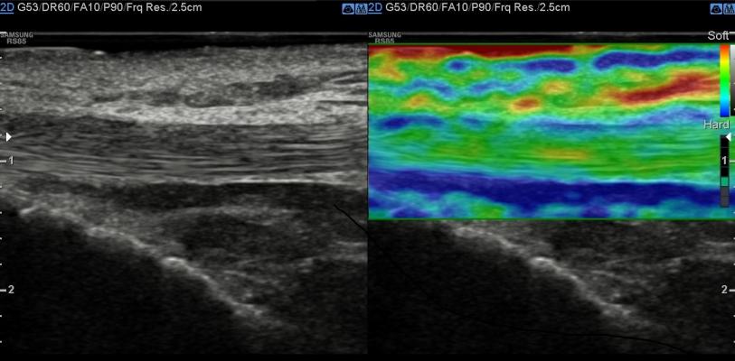 Samsung RS85A Ultrasound Features S-Shearwave Imaging