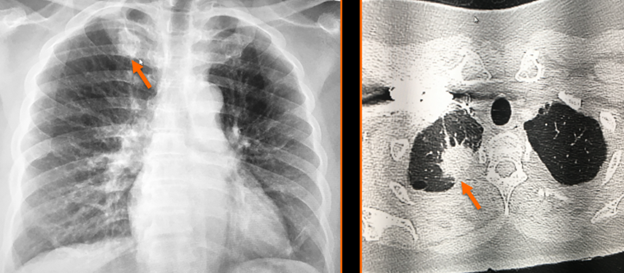 White Medial Clavicle Head: Fig. 1—Sclerosis involving the first anterior costochondral junction, secondary to degenerative changes, is a common finding. In this case, appearance was asymmetric and revelated to be overlapping lung cancer.