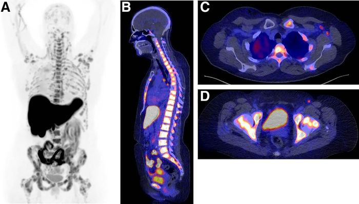 Determination of ER status of disease. In 59-y-old woman diagnosed with ER-positive lobular BC 2 y previously and treated with tamoxifen, ER-positive bone metastases were identified 1 y after initial diagnosis.