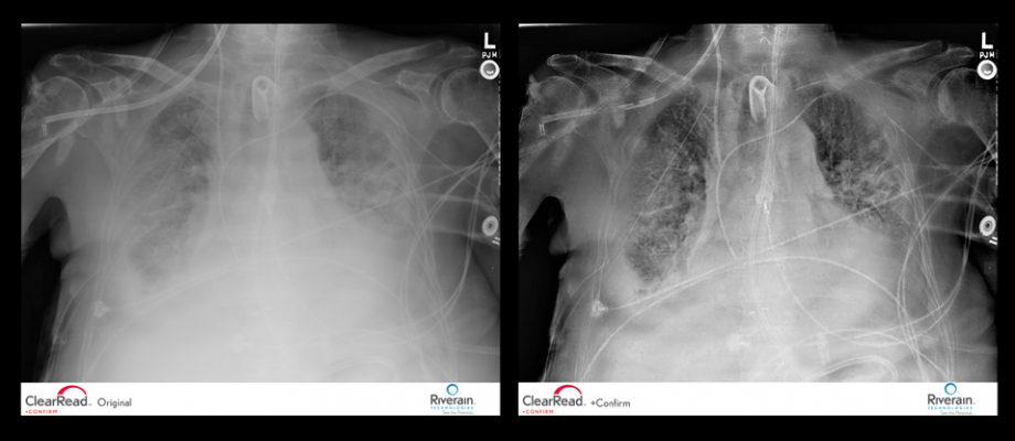 New Studies Confirm Bone Suppression, CAD Improves Lung Cancer Detection