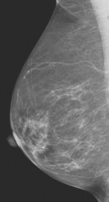 mammography systems women's healthcare imaging rsna 2013 tomosynthesis