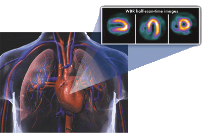 The Ultraspect xpress.cardiac nuclear imaging solution reduced SPECT radiation dose. 