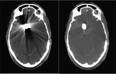 New Siemens Angiography Apps Enhance Diagnostic Capability