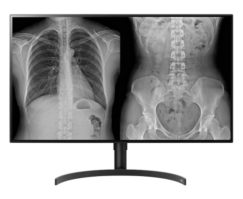 LG’s new 8-megapixel radiology monitor (model 32HL512D – FDA 510k Class II approval is pending) has a larger screen than its 27-inch predecessor and employs LG NanoCell IPS display technology for image quality optimized for accurate reviews