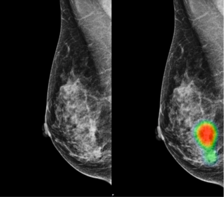 Mammograms of a 49-year-old woman with invasive lobular carcinoma on the right-side breast