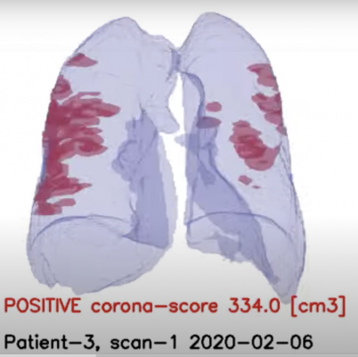 #COVID19 #Coronavirus #2019nCoV #Wuhanvirus #SARScov2 RADLogics announced new worldwide deployments and installations of the company’s AI-powered solution to support chest computed tomography (CT) imaging for COVID-19 (Coronavirus) patients.