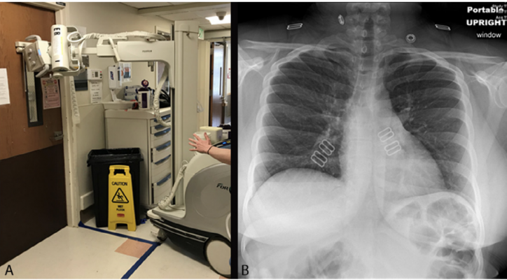 Chest radiography through glass. A, Technologists position the portable x-ray unit outside the patient room, with the tube peering through the mesh wire–reinforced isolation room window. B, Anteroposterior chest radiograph obtained is of diagnostic quality. 