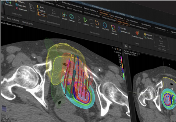 RaySearch Laboratories AB has launched the latest release of its widely adopted treatment planning system. RayStation 10B adds support for brachytherapy planning and a new GPU Monte Carlo algorithm, which typically cuts final dose computation times to less than five seconds.