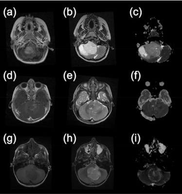 Example MR images from paediatric brain tumour patients. This first column shows T1-weighted images following the injection of gadolinium contrast agent. The second column shows T2-weighted images and the final column shows apparent diffusion coefficient maps calculated from diffusion-weighted images. (a–c) are taken from a patient with a Pilocytic Astrocytoma, (d–f) are from a patient with an Ependymoma and (g–i) were acquired from a patient with a Medulloblastoma.