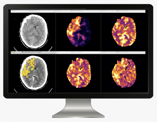 icobrain cva allows the quantitative assessment of tissue perfusion by reporting the volume of core and perfusion lesion by quantifying Tmax abnormality and CBF abnormality together with the mismatch volume and ratio