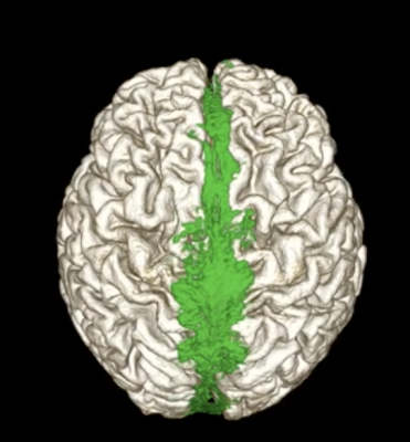 MRI showing the dorsal flow of the brain’s waste clearance system (shown in green). Image courtesy of Dr. Onder Albayram, Medical University of South Carolina