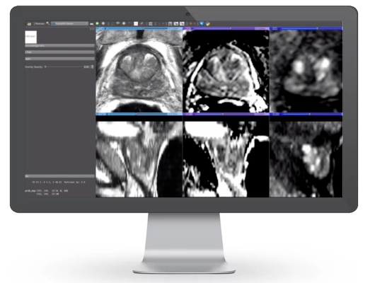 Bot Image, an Omaha-based MRI medical device company has developed an AI-driven medical device CAD software to significantly improve the accuracy and speed of prostate cancer detection (CADe) and diagnosis (CADx). 