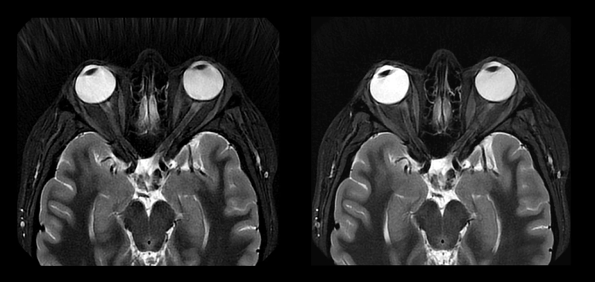 Extending deep learning-based AIR Recon DL compatibility to 3D and PROPELLER has the potential to enable more confident patient diagnoses in MRI 