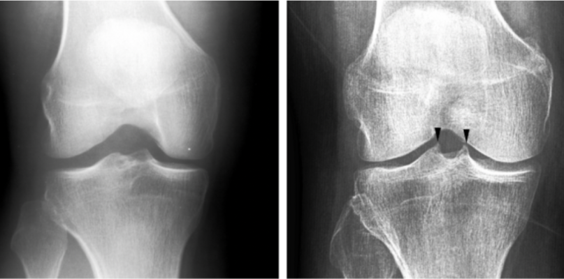 AI tries to detect whether there is spiking on the tibial tubercles in the knee joint or not. Tibial spiking can be a sign of osteoarthritis. Picture: University of Jyväskylä. Image courtesy of the University of Jyväskylä