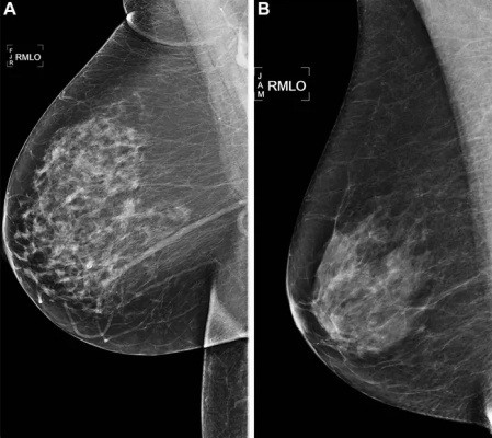 In a large study of thousands of mammograms, artificial intelligence (AI) algorithms outperformed the standard clinical risk model for predicting the five-year risk for breast cancer. The results of the study were published in Radiology, a journal of the Radiological Society of North America (RSNA). 
