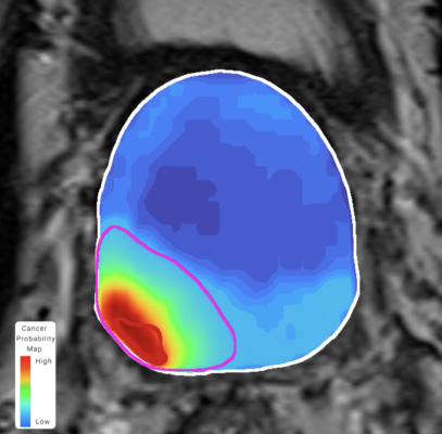 The study found considerable promise for Avenda Health’s machine learning model, Unfold AI, showing it to be effective in encapsulating all of the clinically significant cancer within the prostate (80%) over current standard of care (56%) 