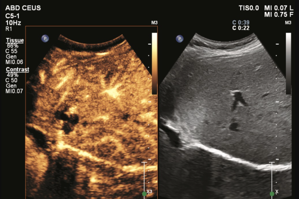 The introduction of a new contrast-enhanced ultrasound (CEUS) application on Philips EPIQ Elite helps enhance diagnostic confidence for cancer patients. 