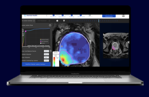 Reimbursement code improves access to personalized prostate cancer care with Avenda Health’s AI cancer mapping platform, Unfold AI  